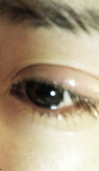 麦粒肿的图片,麦粒肿症状与图片解析